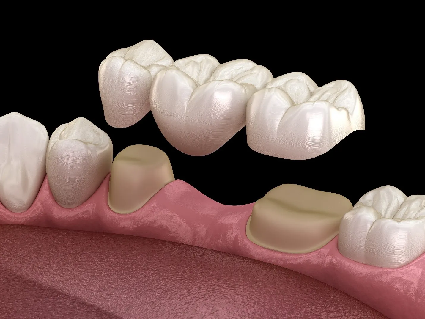 Puentes Dentales
