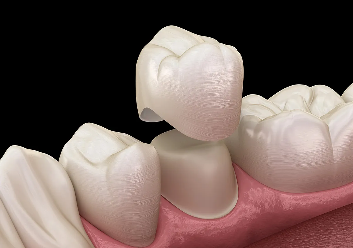 Dental Crowns