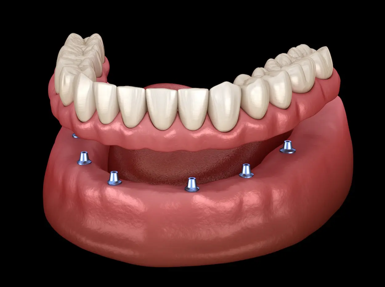 Dentaduras y Dentaduras Parciales