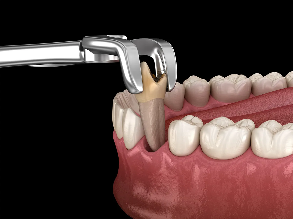 Extracciones Dentales
