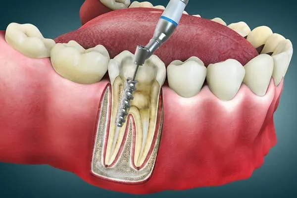 Endodoncia