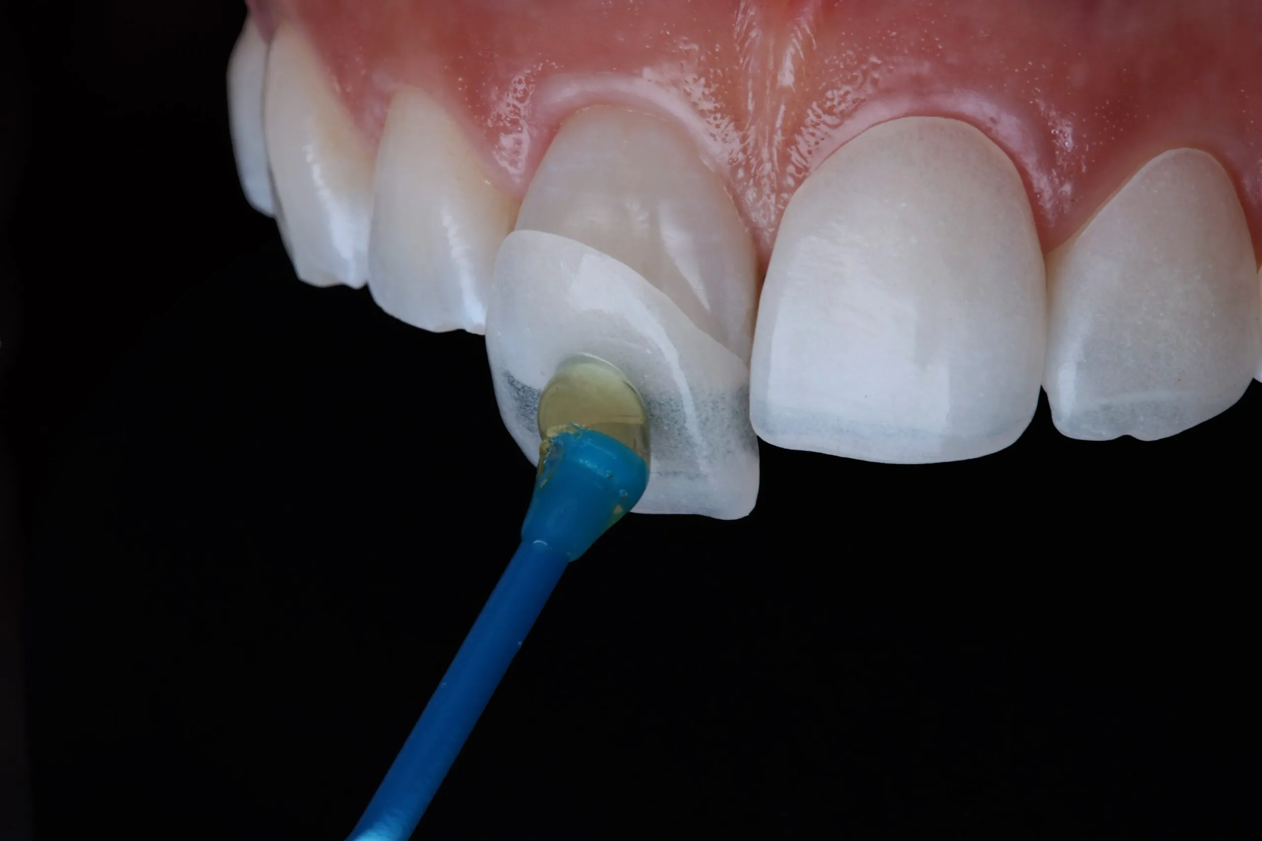 Porcelain Veneers